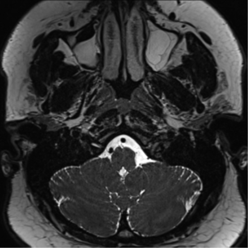 Cerebellopontine angle meningioma (Radiopaedia 48434-53348 Axial T2 Space 23).png