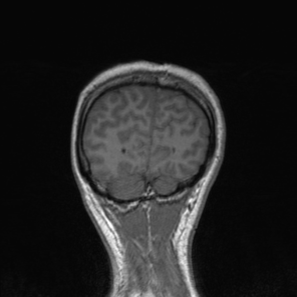 Cerebral abscess (Radiopaedia 24212-24478 Coronal T1 173).jpg