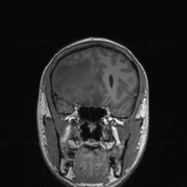 Cerebral abscess (Radiopaedia 24212-24478 Coronal T1 75).jpg