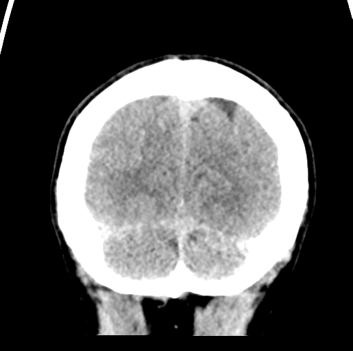Cerebral abscess (Radiopaedia 60342-68008 Coronal non-contrast 56).png