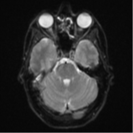 Cerebral abscess (Radiopaedia 60342-68009 Axial DWI 10).png