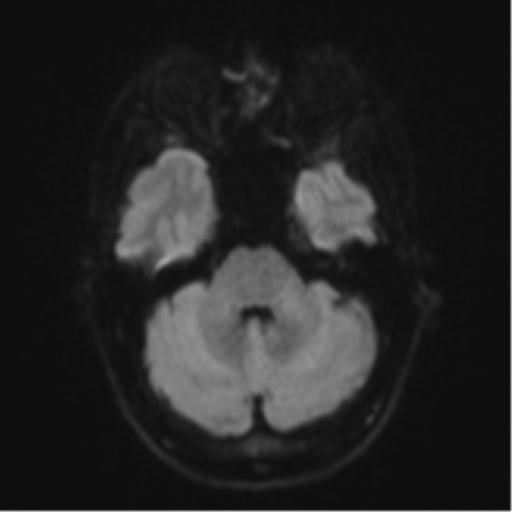 Cerebral abscess (Radiopaedia 60342-68009 Axial DWI 45).png