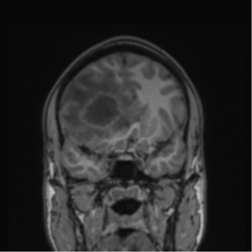 Cerebral abscess (Radiopaedia 60342-68009 Coronal T1 34).png