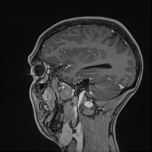 Cerebral abscess (Radiopaedia 60342-68009 J 18).png