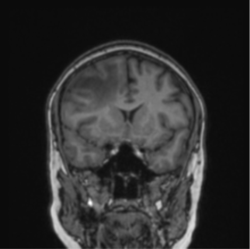 File:Cerebral abscess from pulmonary arteriovenous malformation (Radiopaedia 86275-102291 Coronal T1 59).png