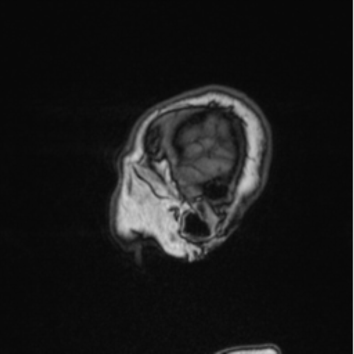 Cerebral abscess from pulmonary arteriovenous malformation (Radiopaedia 86275-102291 Sagittal T1 21).png