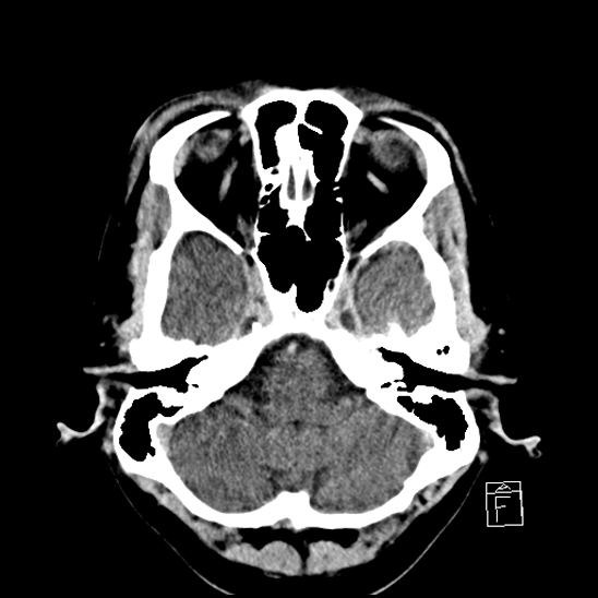 File:Cerebral abscess with ventriculitis (Radiopaedia 78965-91877 A 11).jpg