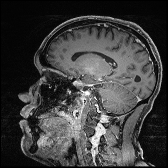 Cerebral abscess with ventriculitis (Radiopaedia 78965-91878 Sagittal T1 C+ 110).jpg
