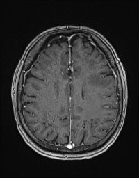 Cerebral amyloid angiopathy-related inflammation (Radiopaedia 58270-65377 Axial T1 C+ fat sat 100).jpg