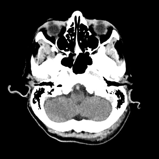 Cerebral amyloid angiopathy-related inflammation (Radiopaedia 74836-85848 Axial non-contrast 13).jpg