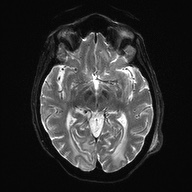 Cerebral amyloid angiopathy-related inflammation (Radiopaedia 74836-85849 Axial DWI 14).jpg