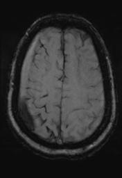 File:Cerebral amyloid angiopathy (Radiopaedia 29129-29518 Axial SWI MPR 28).jpg