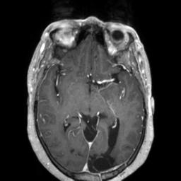 Cerebral amyloid angiopathy (Radiopaedia 29129-29518 Axial T1 C+ 68).jpg