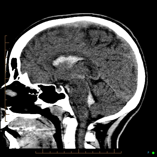 Cerebral arteriovenous malformation (AVM) (Radiopaedia 78162-90706 A 40).jpg