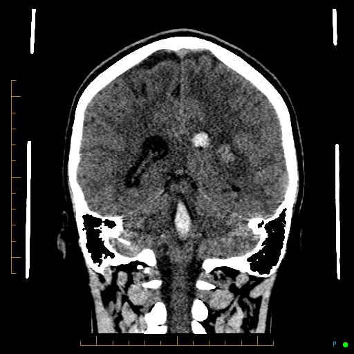 Cerebral arteriovenous malformation (AVM) (Radiopaedia 78162-90706 Coronal non-contrast 64).jpg