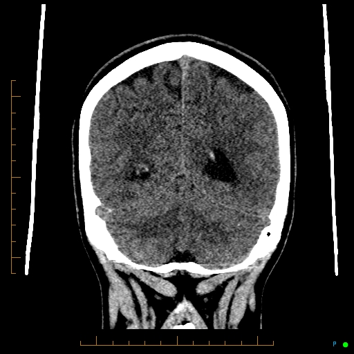 Cerebral arteriovenous malformation (AVM) (Radiopaedia 78162-90706 Coronal non-contrast 73).jpg