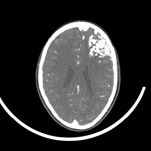 Cerebral arteriovenous malformation (Radiopaedia 29531-30031 E 59).jpg