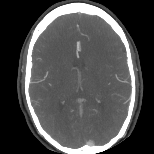 Cerebral arteriovenous malformation (Radiopaedia 39259-41505 AX CEREBRAL CTA 32).png