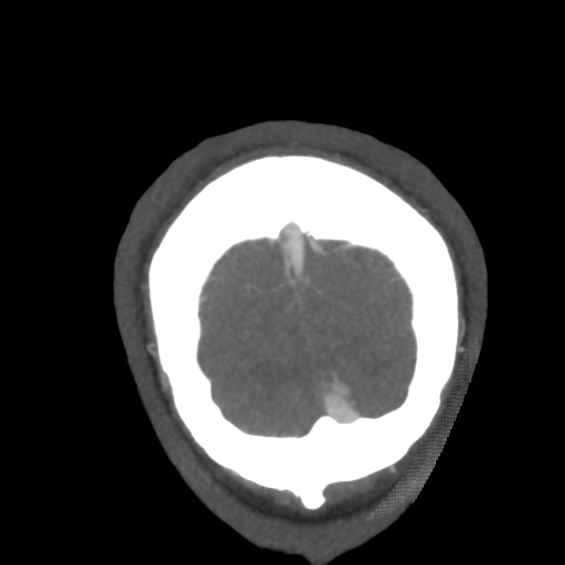 Cerebral arteriovenous malformation (Radiopaedia 39259-41505 E 67).png