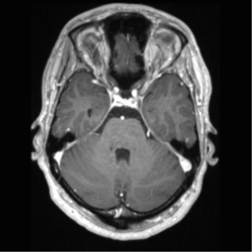 File:Cerebral arteriovenous malformation (Radiopaedia 39259-41506 AX T1 MPR C+ 21).png
