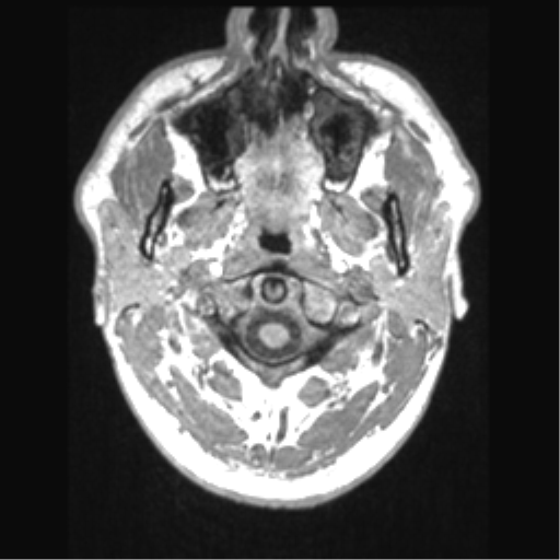 Cerebral arteriovenous malformation (Radiopaedia 39259-41506 Axial T1 1).png
