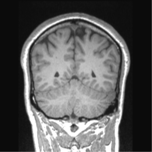 File:Cerebral arteriovenous malformation (Radiopaedia 39259-41506 Coronal T1 28).png