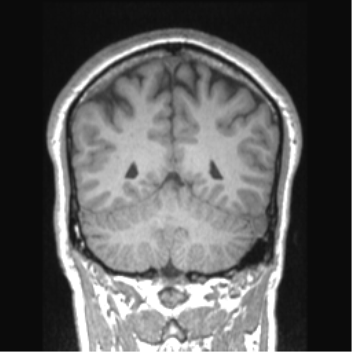 File:Cerebral arteriovenous malformation (Radiopaedia 39259-41506 Coronal T1 29).png
