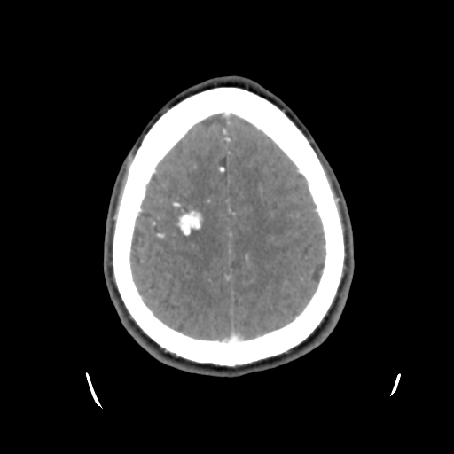 Cerebral arteriovenous malformation (Radiopaedia 55798-62371 B 41).png