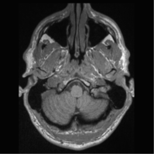 Cerebral arteriovenous malformation (Radiopaedia 55798-62372 Axial T1 4).png