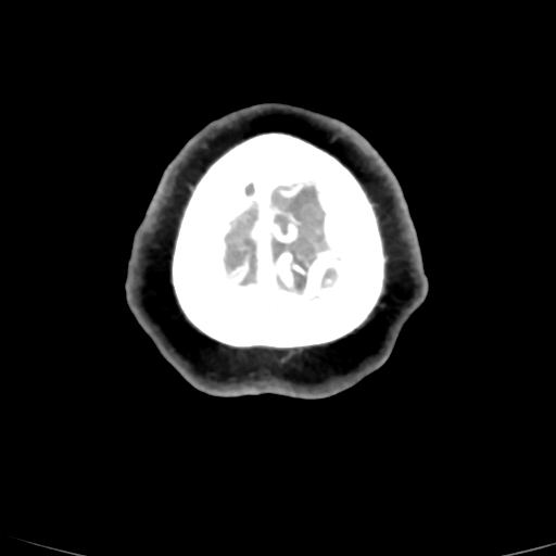 File:Cerebral arteriovenous malformation (Radiopaedia 73830-84645 B 6).jpg