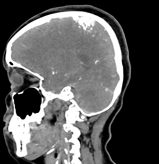 Cerebral arteriovenous malformation (Radiopaedia 73830-84645 D 60).jpg