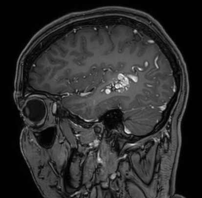 Cerebral arteriovenous malformation (Radiopaedia 74411-85654 Sagittal T1 C+ 29).jpg