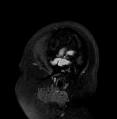 Cerebral arteriovenous malformation (Radiopaedia 74411-85746 Sagittal FLAIR 2).jpg