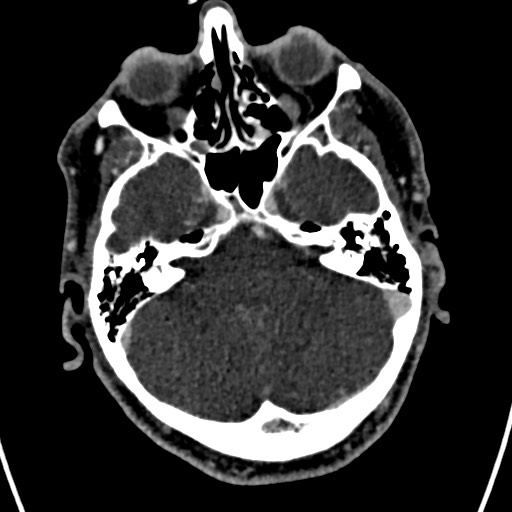 Cerebral arteriovenous malformation (Radiopaedia 78188-90746 Axial C+ delayed 44).jpg