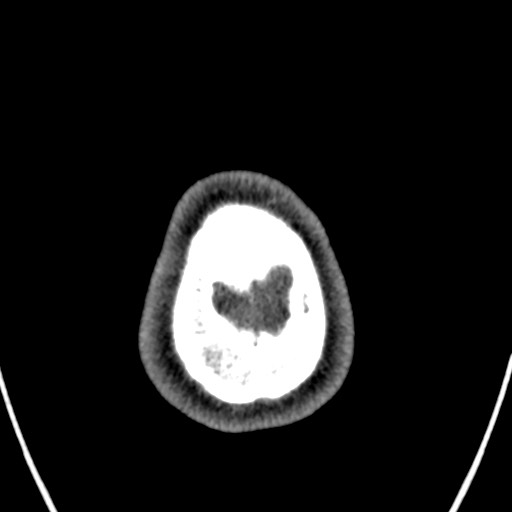 File:Cerebral arteriovenous malformation (Radiopaedia 78188-90746 Axial non-contrast 176).jpg