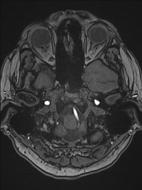 File:Cerebral arteriovenous malformation (Radiopaedia 84015-99245 Axial TOF 62).jpg