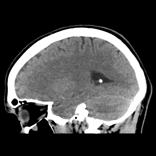 File:Cerebral arteriovenous malformation (Spetzler-Martin grade 2) (Radiopaedia 41262-44076 A 41).png