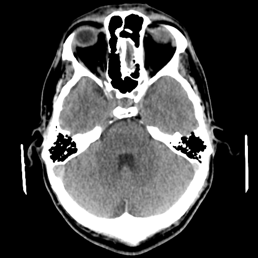 Cerebral arteriovenous malformation (Spetzler-Martin grade 2) (Radiopaedia 41262-44076 Axial non-contrast 18).png