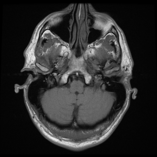 File:Cerebral arteriovenous malformation (Spetzler-Martin grade 2) (Radiopaedia 41262-44092 Axial T1 2).png