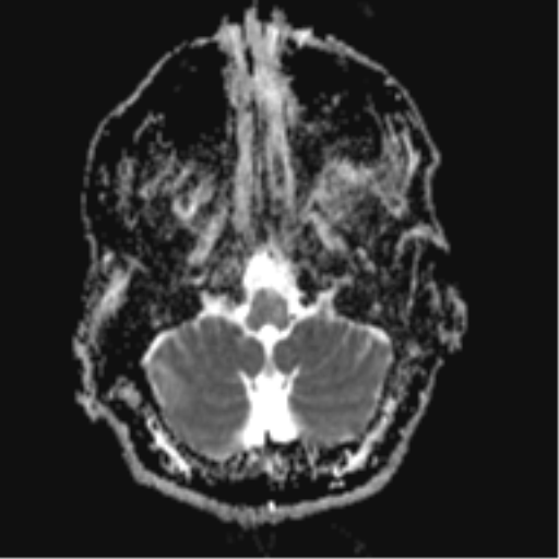 File:Cerebral arteriovenous malformation - huge (Radiopaedia 35734-37272 Axial ADC 4).png