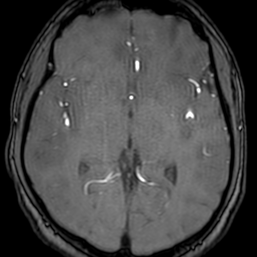 Cerebral arteriovenous malformation at posterior body of corpus callosum (Radiopaedia 74111-84925 Axial MRA 105).jpg