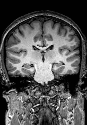 Cerebral arteriovenous malformation at posterior body of corpus callosum (Radiopaedia 74111-84925 Coronal T1 191).jpg