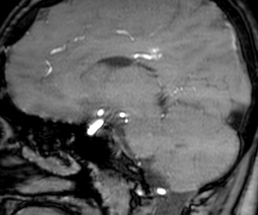 Cerebral arteriovenous malformation at posterior body of corpus callosum (Radiopaedia 74111-84925 J 170).jpg