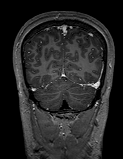 Cerebral arteriovenous malformation at posterior body of corpus callosum (Radiopaedia 74111-84925 K 308).jpg