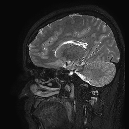Cerebral arteriovenous malformation at posterior body of corpus callosum (Radiopaedia 74111-84925 Sagittal T2 81).jpg