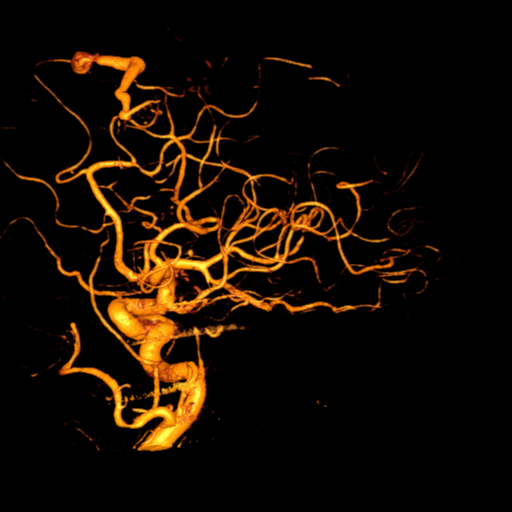 Cerebral arteriovenous malformation with lobar hemorrhage (Radiopaedia 44725-48513 Lateral 23).png