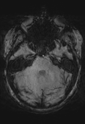File:Cerebral cavernoma and development venous anomaly (Radiopaedia 37603-39482 Axial SWI 11).png
