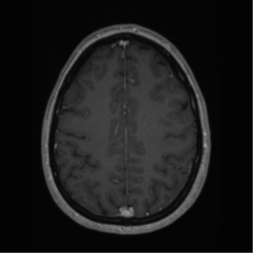 Cerebral cavernoma and development venous anomaly (Radiopaedia 37603-39482 Axial T1 C+ 55).png
