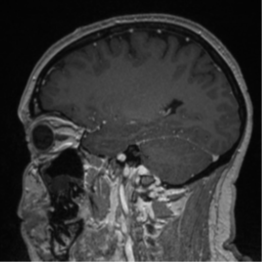 File:Cerebral cavernoma and development venous anomaly (Radiopaedia 37603-39482 Sagittal T1 C+ 34).png