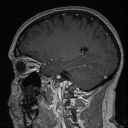 Cerebral cavernoma and development venous anomaly (Radiopaedia 37603-39482 Sagittal T1 C+ 35).png